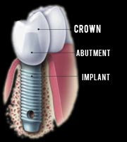 Implants