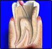 Root Canal